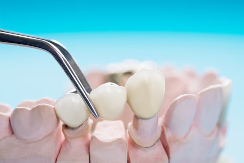 What Are The Symptoms Of Needing A Dental Crown?