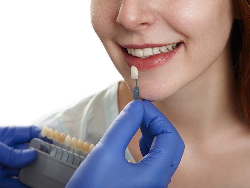 can dental veneers look like your real teeth